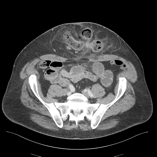 Adhesions within abdominal wall hernia (Radiopaedia 58283-65394 Axial C+ portal venous phase 61).png