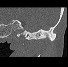 File:Adhesive chronic otitis media (Radiopaedia 14270-14148 Coronal bone window - left 1).jpg