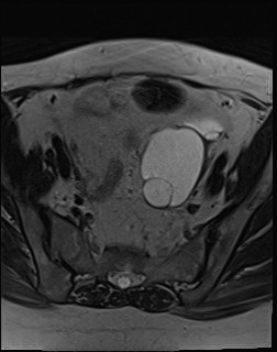 File:Adnexal multilocular cyst (O-RADS US 3- O-RADS MRI 3) (Radiopaedia 87426-103754 Axial T2 8).jpg
