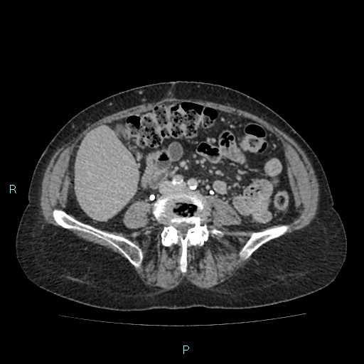 File:Adrenal collision tumor (ACT) (Radiopaedia 48462-53379 Axial C+ delayed 39).jpg