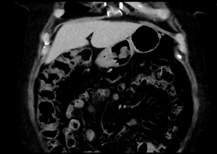 File:Adrenal cortical carcinoma (Radiopaedia 64017-72769 Coronal C+ portal venous phase 12).jpg