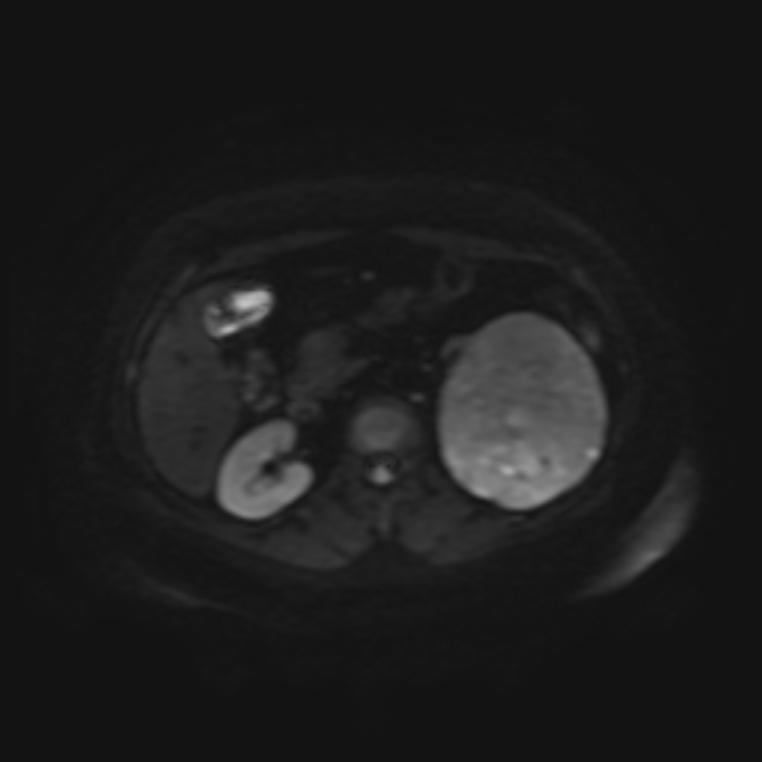 Adrenal cortical carcinoma (Radiopaedia 70906-81116 Axial DWI 14).jpg