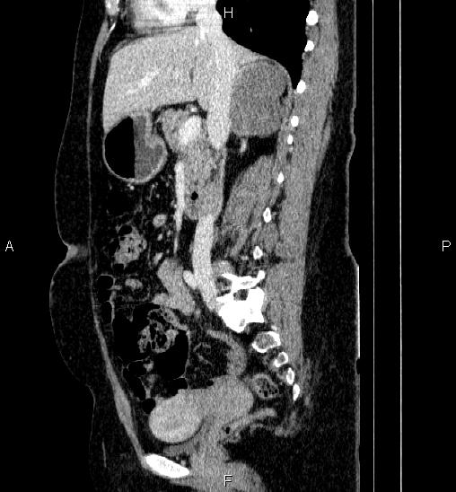 Adrenal cortical carcinoma (Radiopaedia 84882-100379 Sagittal C+ portal venous phase 40).jpg