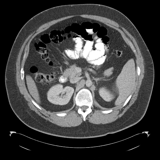 Adrenal cyst (Radiopaedia 45625-49776 Axial C+ portal venous phase 35).png