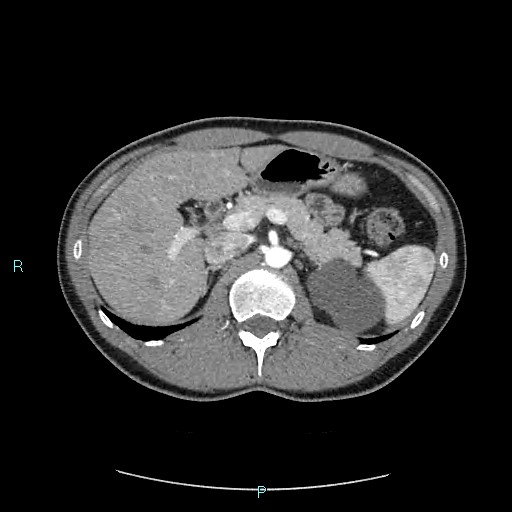 Adrenal cystic lymphangioma (Radiopaedia 83161-97534 Axial C+ arterial phase 30).jpg