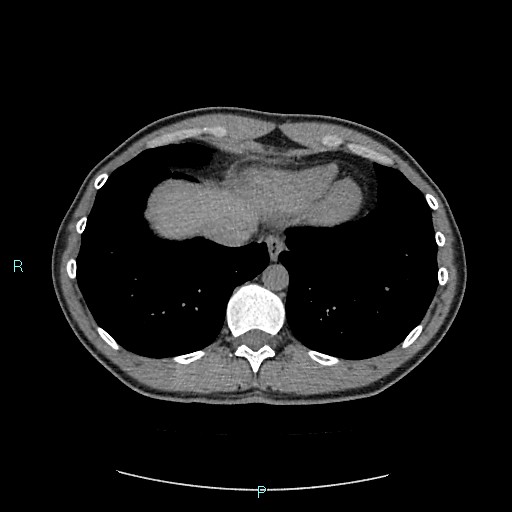 Adrenal cystic lymphangioma (Radiopaedia 83161-97534 Axial non-contrast 13).jpg