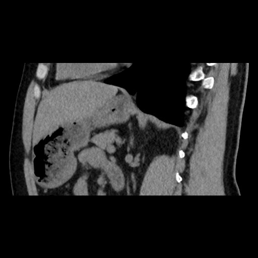 File:Adrenal gland trauma (Radiopaedia 81351-95079 Sagittal non-contrast 61).jpg