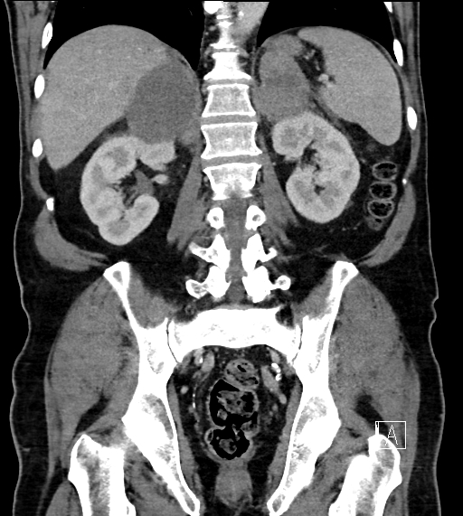 Adrenal lymphoma (Radiopaedia 73730-84529 Coronal C+ portal venous phase 55).jpg