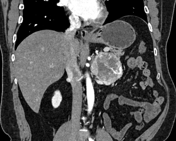 Adrenal metastases (Radiopaedia 73082-83791 Coronal C+ arterial phase 23).jpg