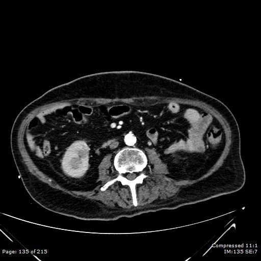 Adrenal metastasis (Radiopaedia 78425-91079 Axial C+ arterial phase 65).jpg