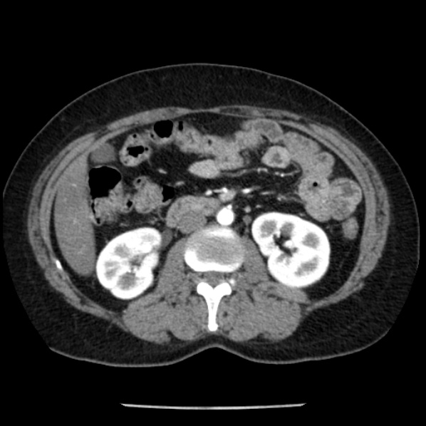 Adrenal myelolipoma (Radiopaedia 43401-46759 Axial C+ arterial phase 48).jpg