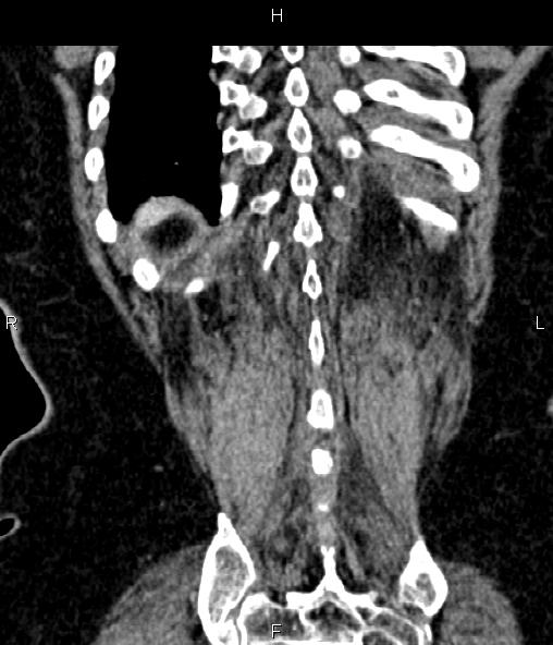 File:Adrenal myelolipoma (Radiopaedia 82742-96986 Coronal renal cortical phase 67).jpg