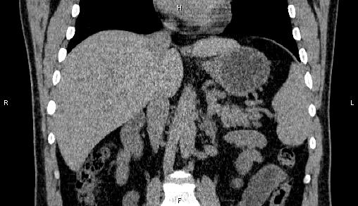 Adrenal myelolipoma (Radiopaedia 84321-99619 Coronal non-contrast 43).jpg