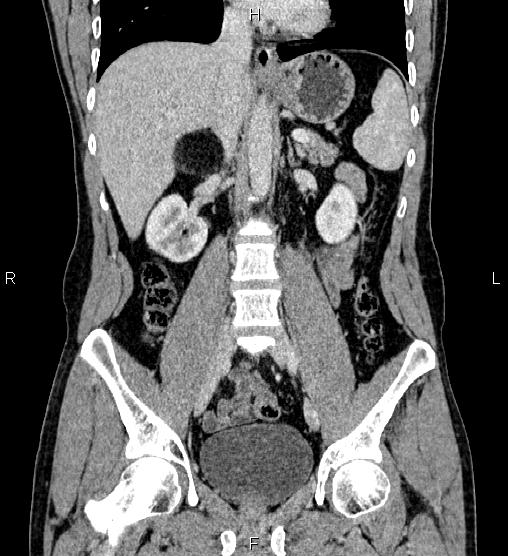 Adrenal myelolipoma (Radiopaedia 87794-104246 Coronal renal cortical phase 34).jpg