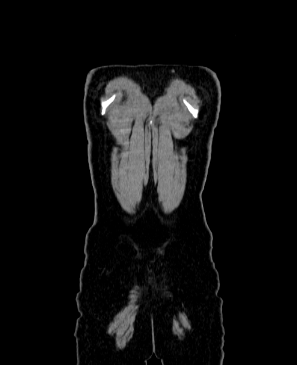 Adrenocortical carcinoma (Radiopaedia 80134-93438 Coronal C+ portal venous phase 163).jpg