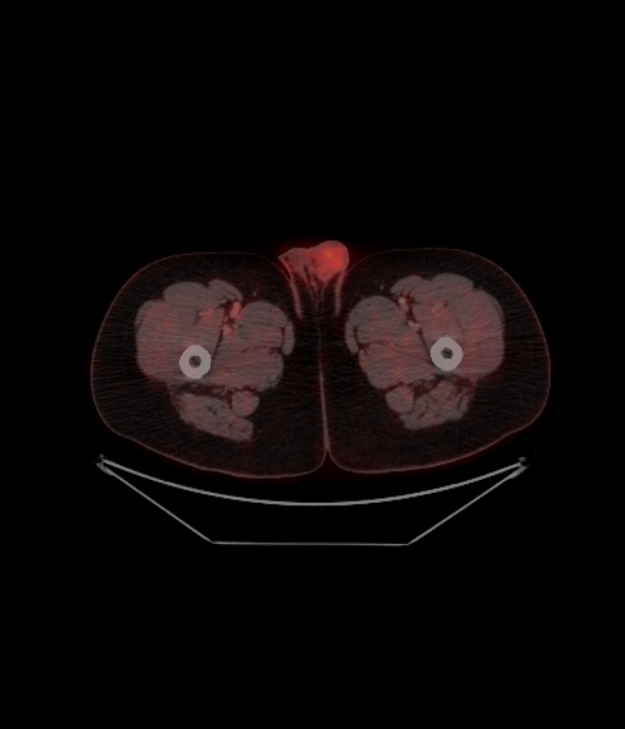 Adrenocortical carcinoma (Radiopaedia 80134-93440 ِAxial 279).jpg