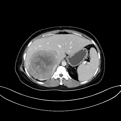 Adrenocortical carcinoma (Radiopaedia 87281-103569 Axial C+ portal venous phase 22).jpg