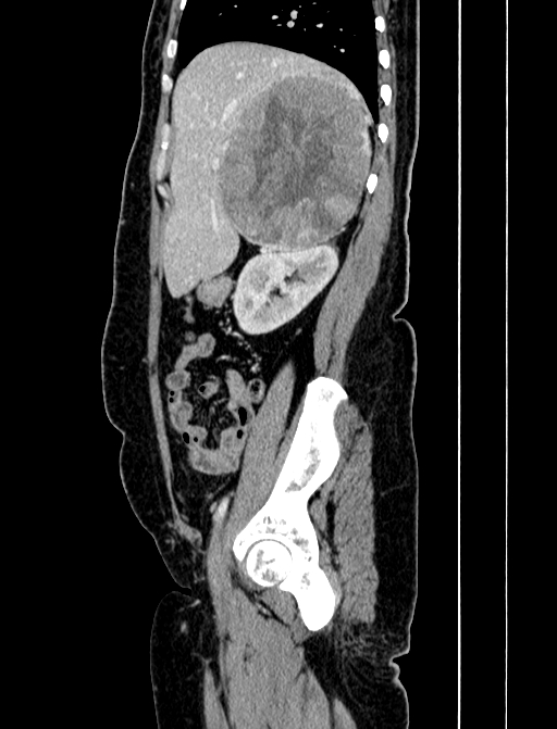 Adrenocortical carcinoma (Radiopaedia 87281-103569 Sagittal C+ portal venous phase 74).jpg
