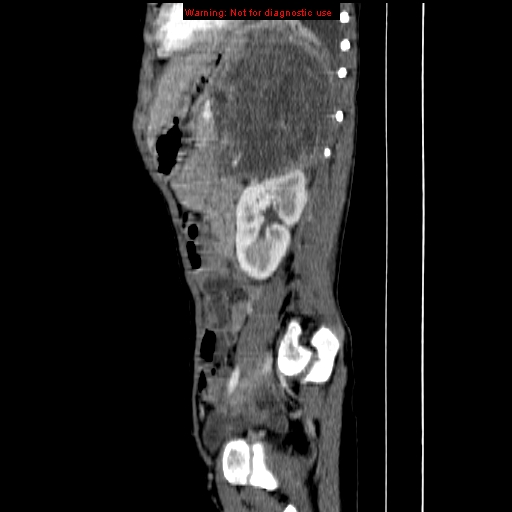 File:Adrenocortical carcinoma (Radiopaedia 9449-10131 Sagittal C+ portal venous phase 12).jpg