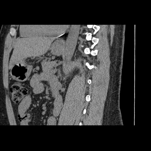 Adult polycystic kidney disease (Radiopaedia 59075-66368 Sagittal non-contrast 51).jpg