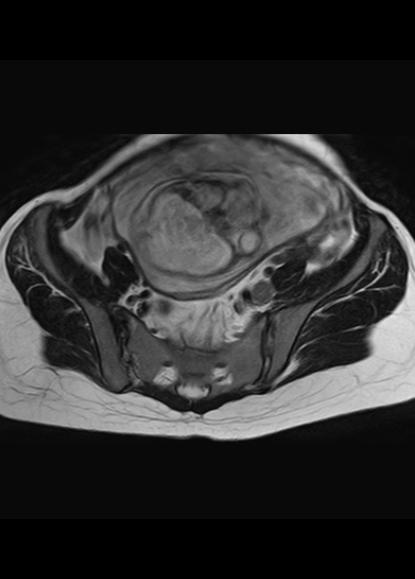 File:Aggressive angiomyxoma of the pelvis and perineum (Radiopaedia 59162-66479 Axial T2 20).jpg