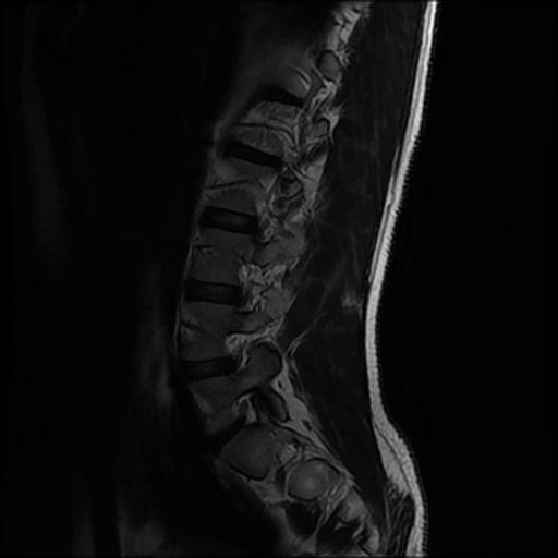File:Aggressive vertebral hemangioma with pathological fracture (Radiopaedia 69528-79411 Sagittal T2 1).jpg