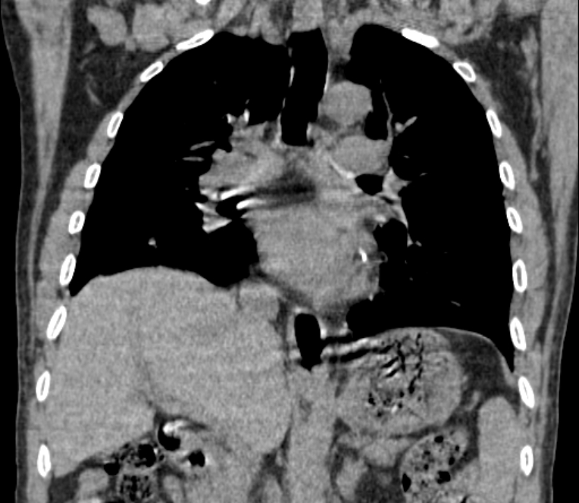 Airway foreign body in adult (Radiopaedia 85907-101779 Coronal liver window 141).jpg