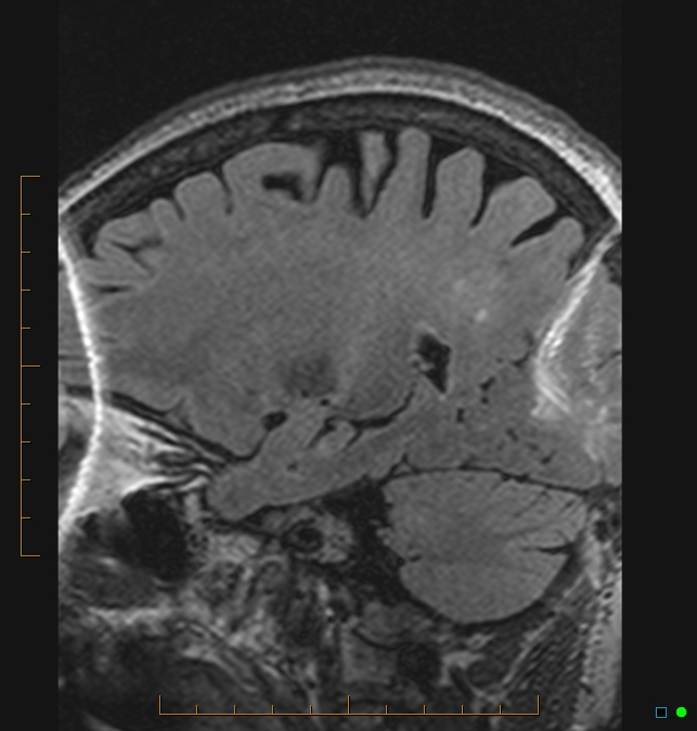 Aliasing artifact causing a spurious cerebellar lesion (Radiopaedia 48783-53810 Sagittal FLAIR 80).jpg