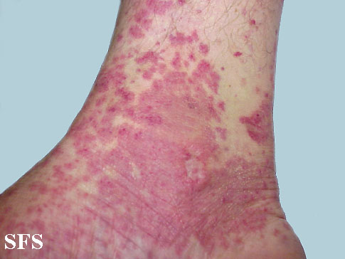Allergic Vasculitis (Dermatology Atlas 3).jpg