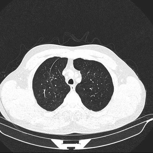 File:Allergic bronchopulmonary aspergillosis (Radiopaedia 21386-21320 Axial lung window 7).jpg