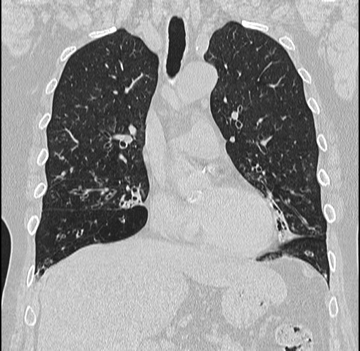 Alpha-1-antitrypsin deficiency (Radiopaedia 72058-82557 Coronal lung window 30).jpg