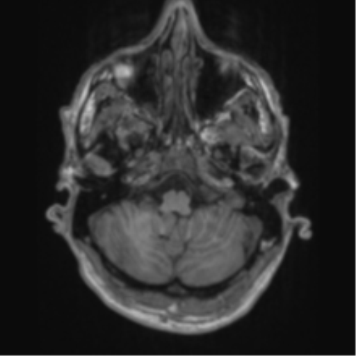 File:Alzheimer's disease- with apraxia (Radiopaedia 54763-61011 Axial T1 14).png