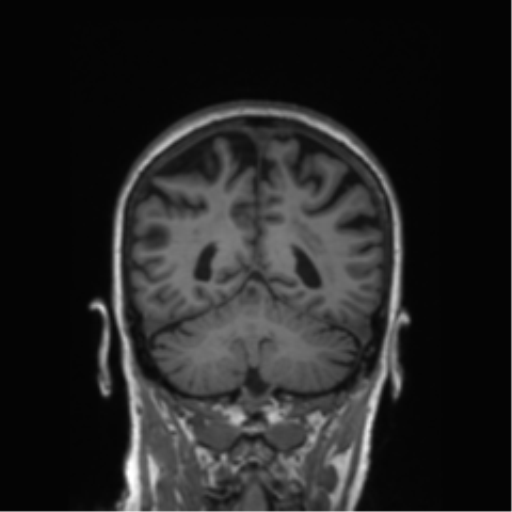 Alzheimer's disease (Radiopaedia 42658-45802 Coronal T1 63).png