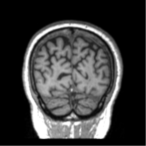Alzheimer disease and cerebral amyloid angiopathy (Radiopaedia 64234-73011 Coronal T1 1).png