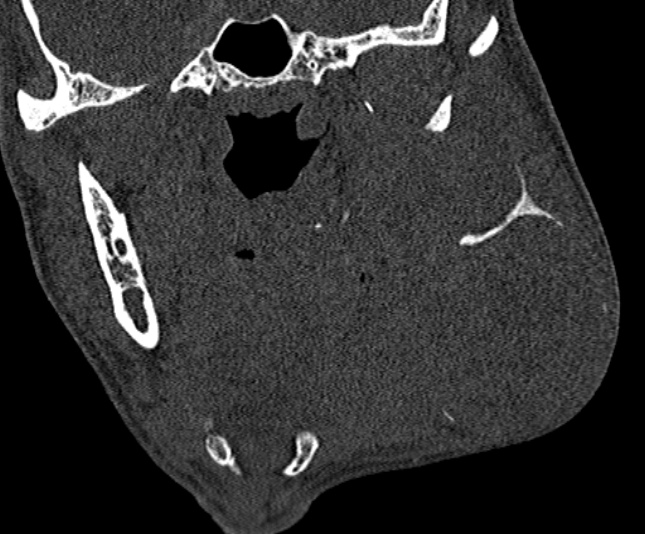 Ameloblastoma (Radiopaedia 51921-57766 Coronal bone window 148).jpg