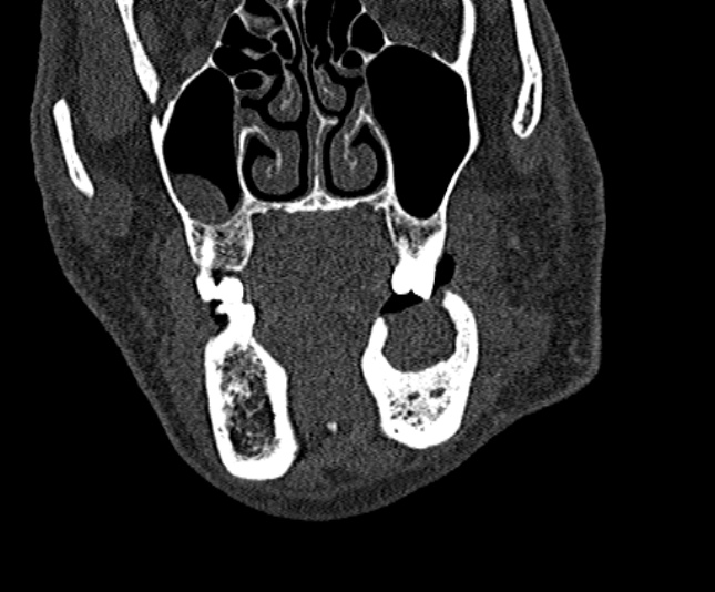 Ameloblastoma (Radiopaedia 51921-57766 Coronal bone window 71).jpg