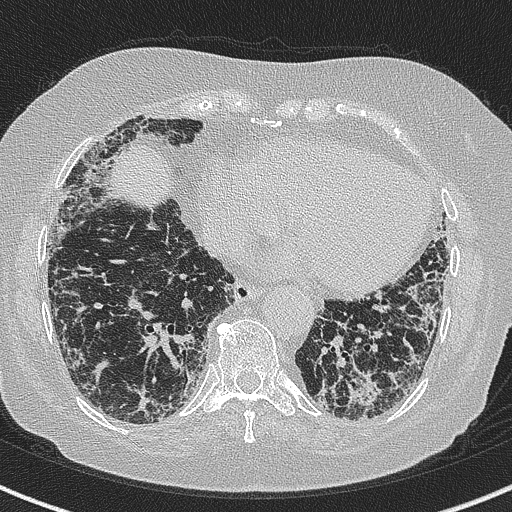 File:Amiodarone-induced pulmonary fibrosis (Radiopaedia 82355-96460 Axial lung window 49).jpg
