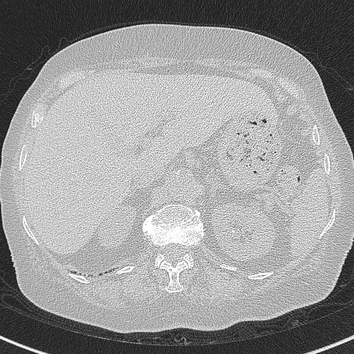 Amiodarone-induced pulmonary fibrosis (Radiopaedia 82355-96460 Axial lung window 68).jpg
