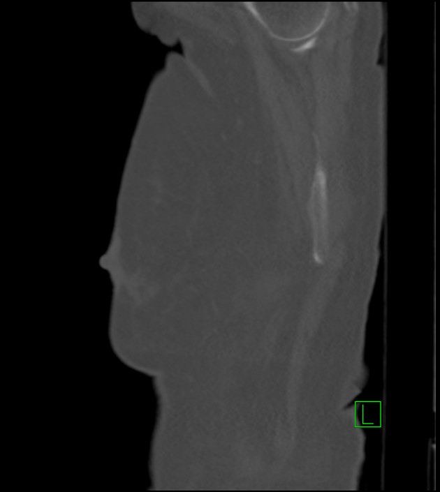 Amiodarone deposition in the liver (Radiopaedia 77587-89780 Sagittal bone window 92).jpg