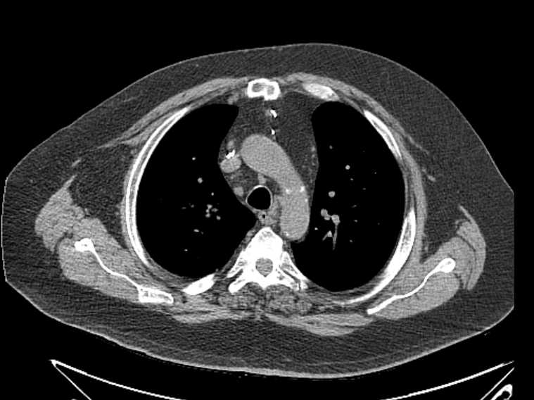 Amiodarone lung (Radiopaedia 62514-70769 Axial non-contrast 27).jpg
