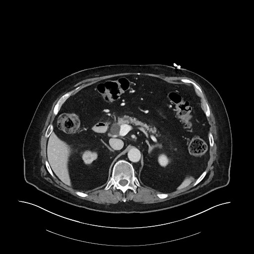 File:Ampullary adenocarcinoma (Radiopaedia 59373-66734 C 52).jpg
