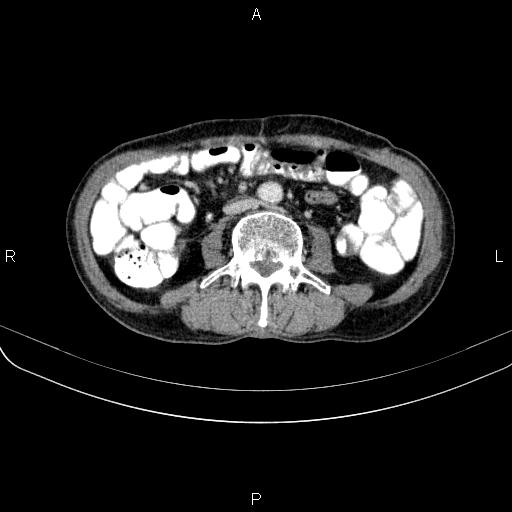 File:Ampullary adenocarcinoma (Radiopaedia 86093-102033 B 76).jpg