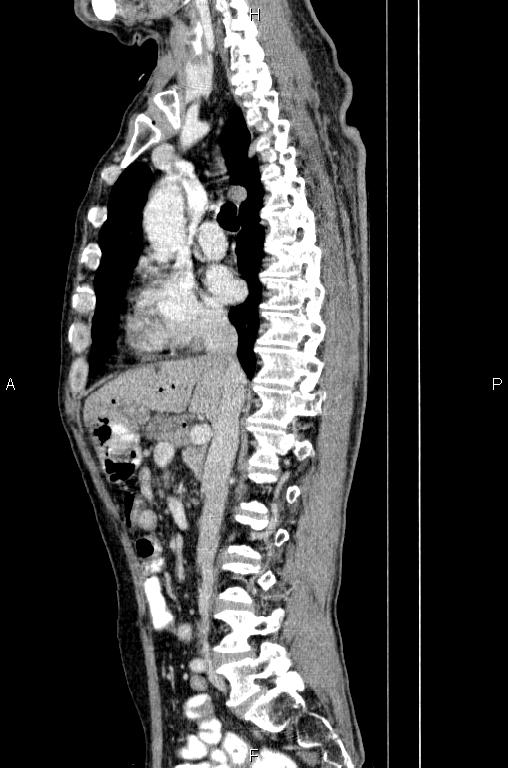 Ampullary adenocarcinoma (Radiopaedia 86093-102033 E 40).jpg