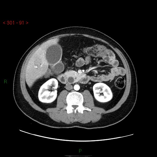 Ampullary carcinoma (Radiopaedia 56396-63056 B 37).jpg