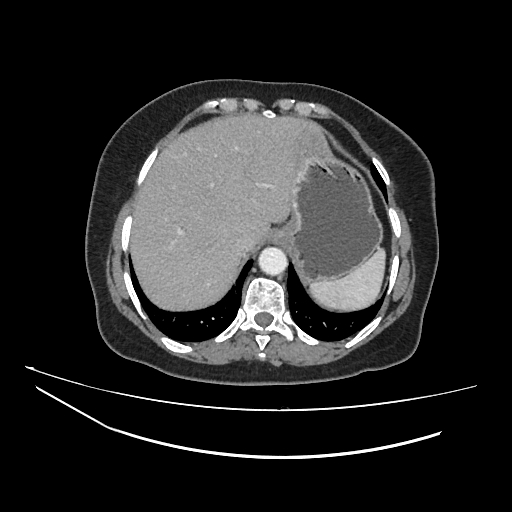 File:Ampullary tumor (Radiopaedia 60333-67998 A 7).jpg