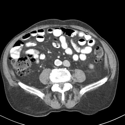 File:Amyand hernia (Radiopaedia 39300-41547 A 41).png