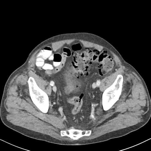 File:Amyand hernia (Radiopaedia 39300-41547 A 60).png