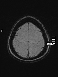 File:Amyotrophic lateral sclerosis (Radiopaedia 70821-81017 Axial SWI 50).jpg