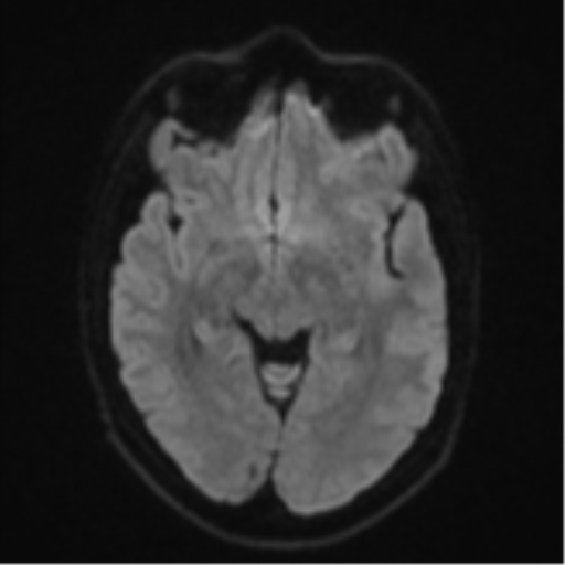 Anaplastic astrocytoma (Radiopaedia 57768-64731 Axial DWI 40).png