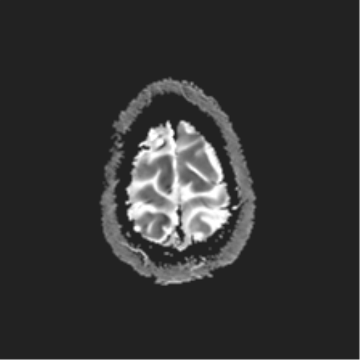 File:Anaplastic astrocytoma IDH mutant (Radiopaedia 50046-55341 Axial ADC 26).png